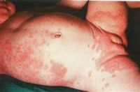 atopis dermatitis.jpg